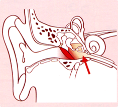 急性中耳炎の図