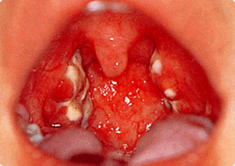 【写真】急性・慢性扁桃炎